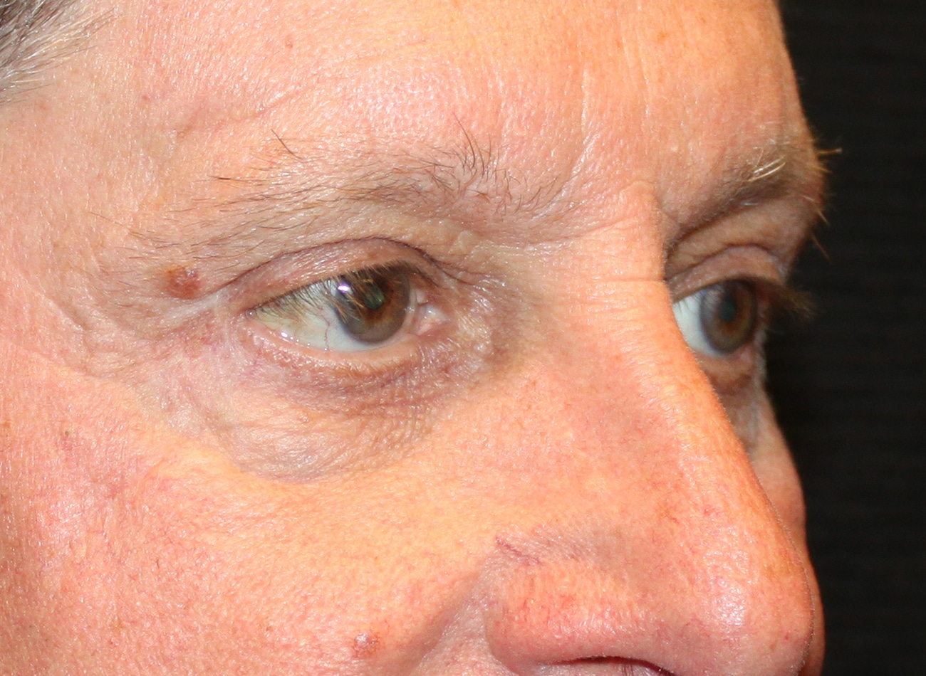 Patient #12832: Bilateral Upper & Lower Blepharoplasty After Image