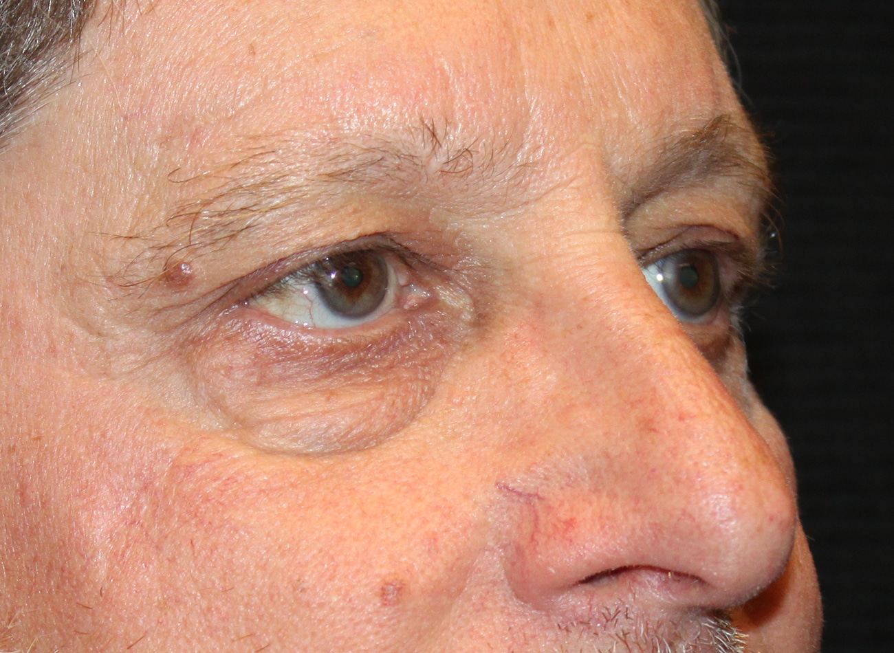 Patient #12832: Bilateral Upper & Lower Blepharoplasty Before Image