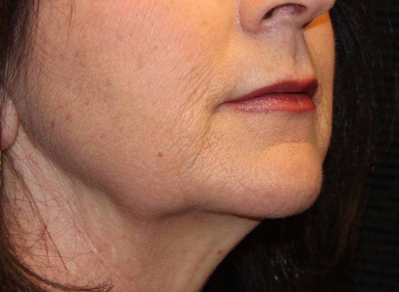 Patient #96750: Juvéderm Ultra After Image