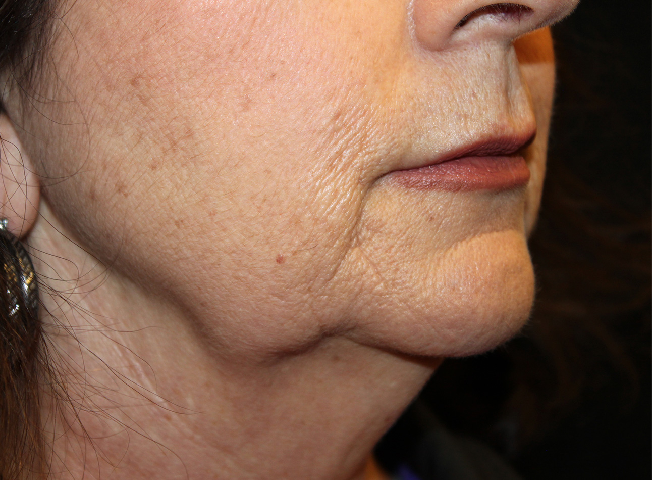 Patient #96750: Juvéderm Ultra Before Image