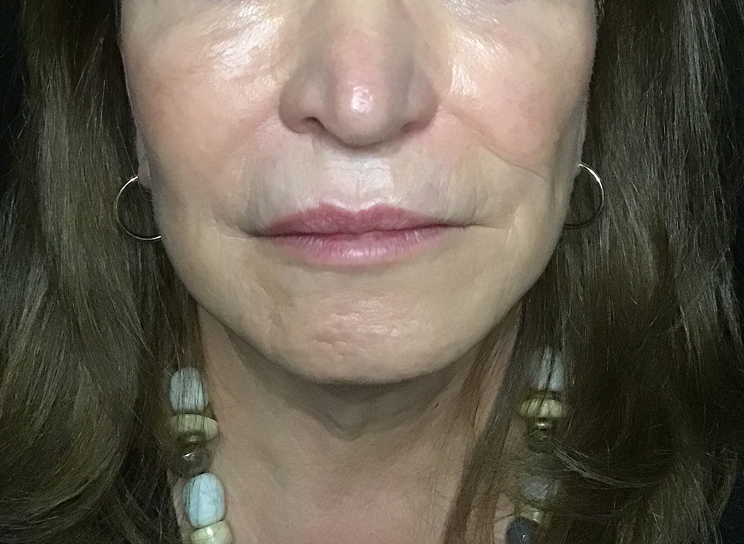 Patient #49752: Volbella After Image