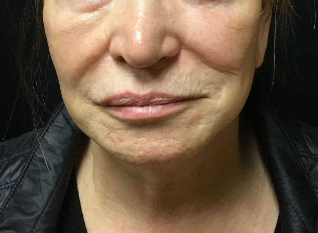 Patient #49752: Volbella Before Image
