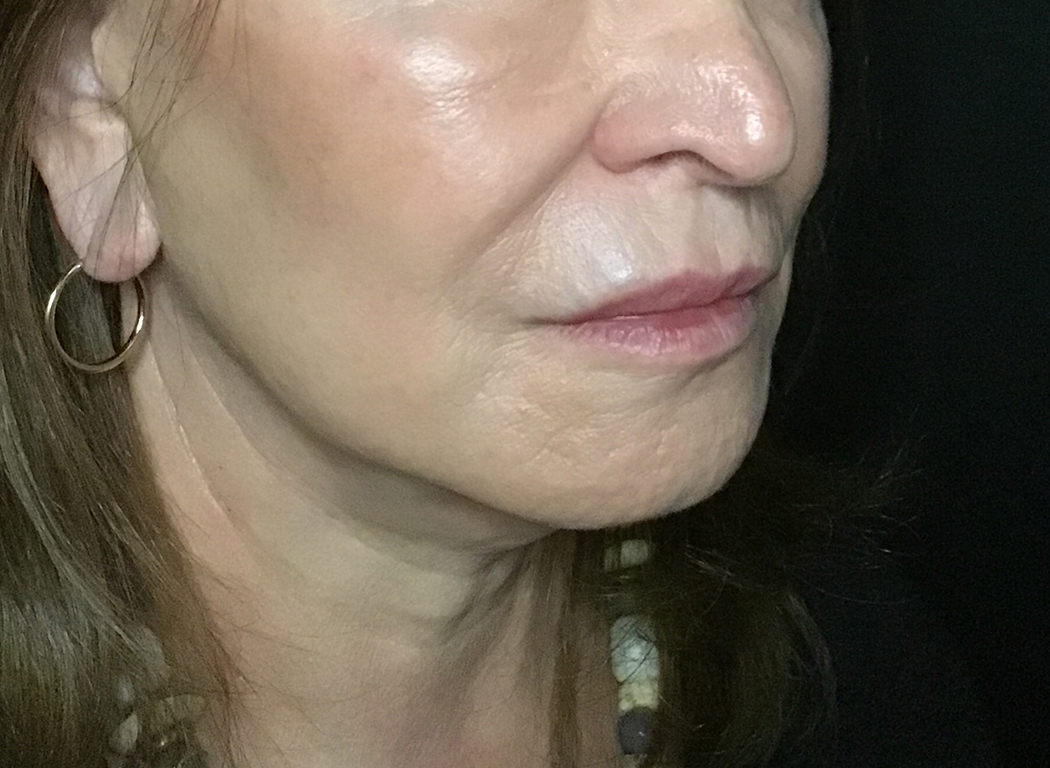 Patient #49752: Volbella After Image