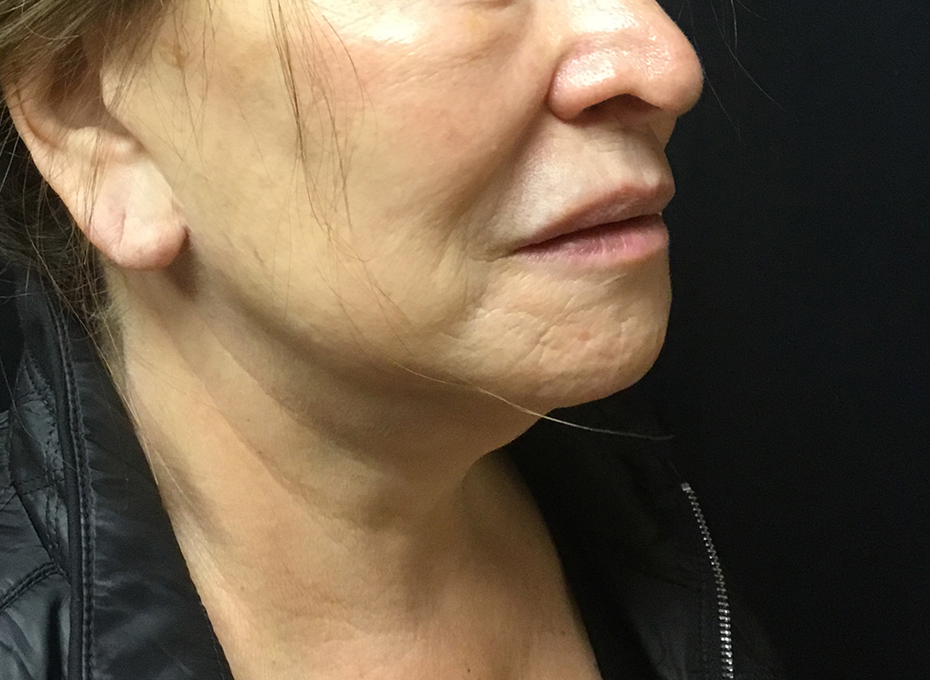 Patient #49752: Volbella Before Image
