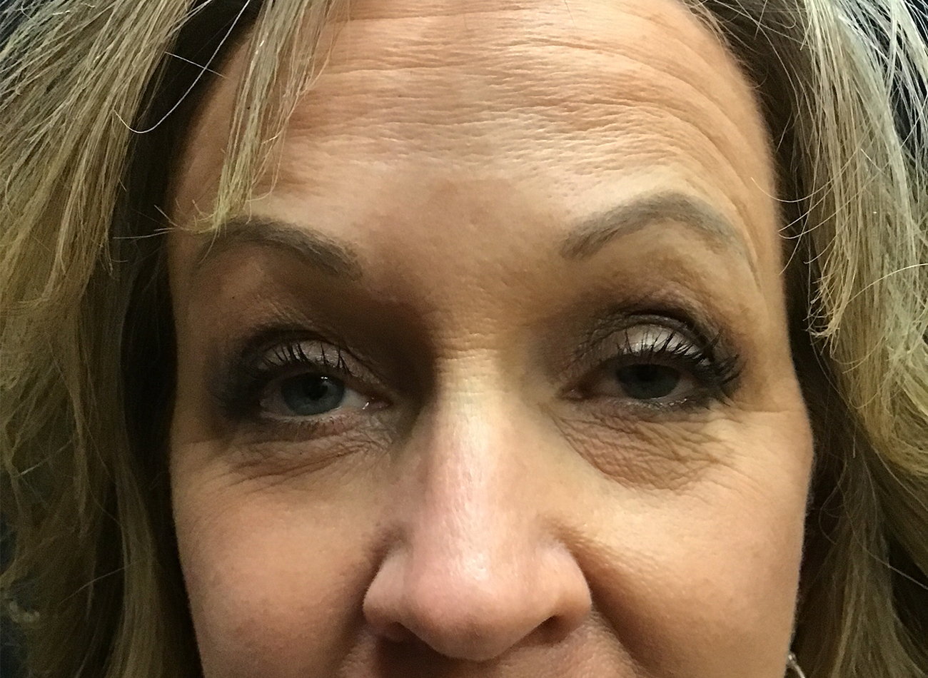 Patient #28366: Jeuveau After Image