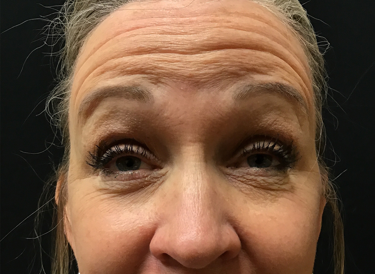 Patient #28366: Jeuveau Before Image