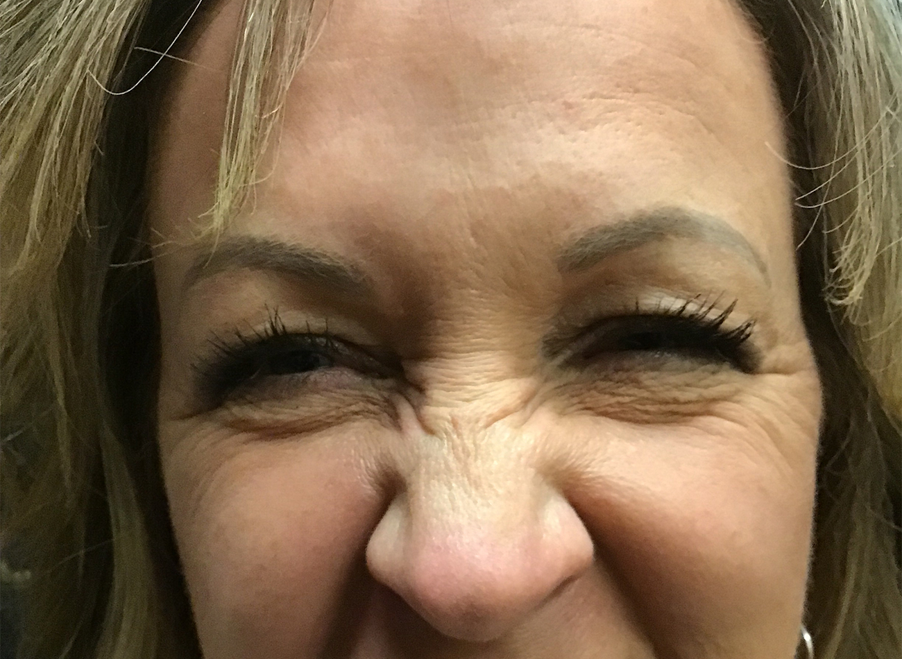 Patient #28366: Jeuveau After Image