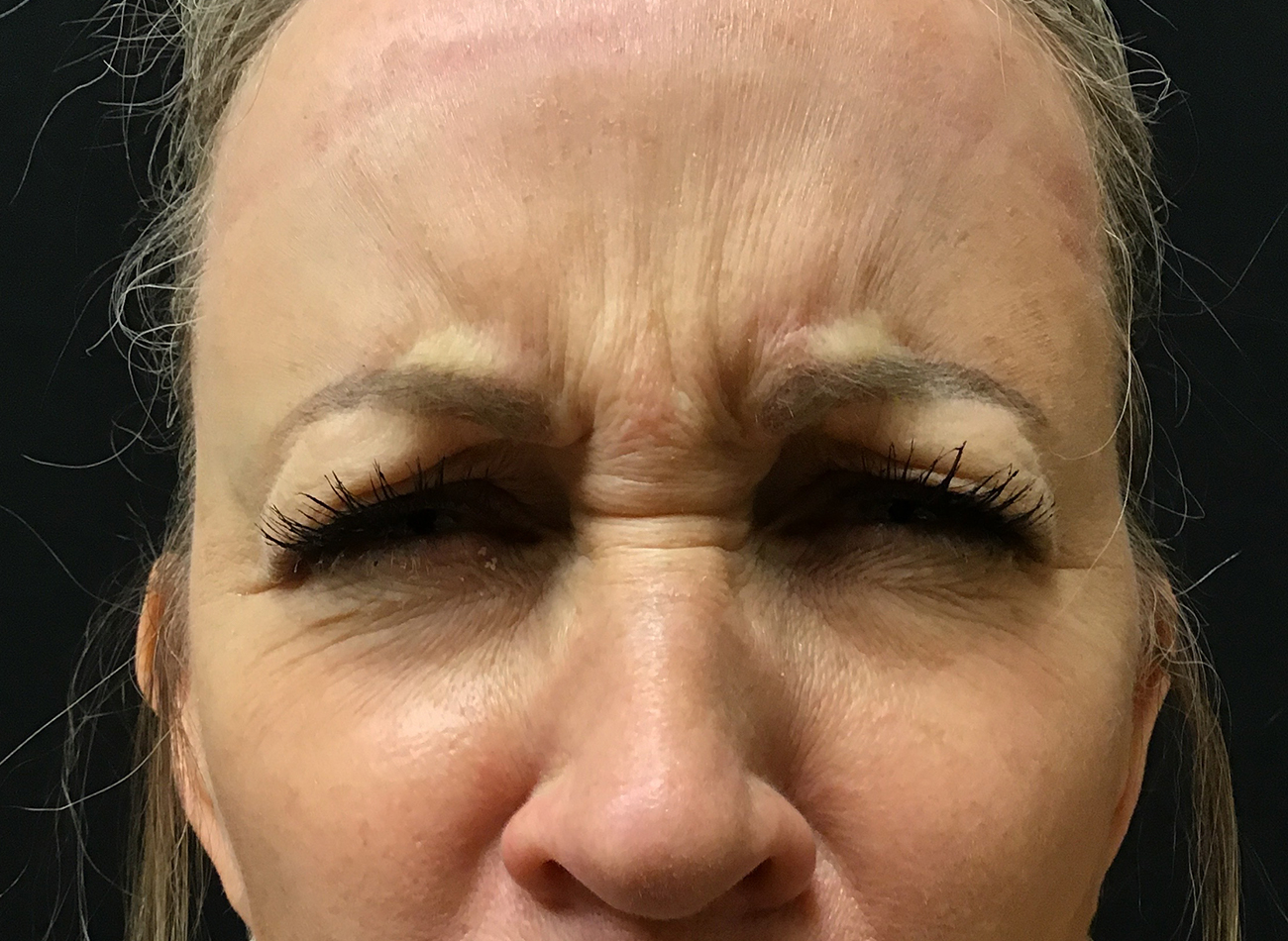 Patient #28366: Jeuveau Before Image