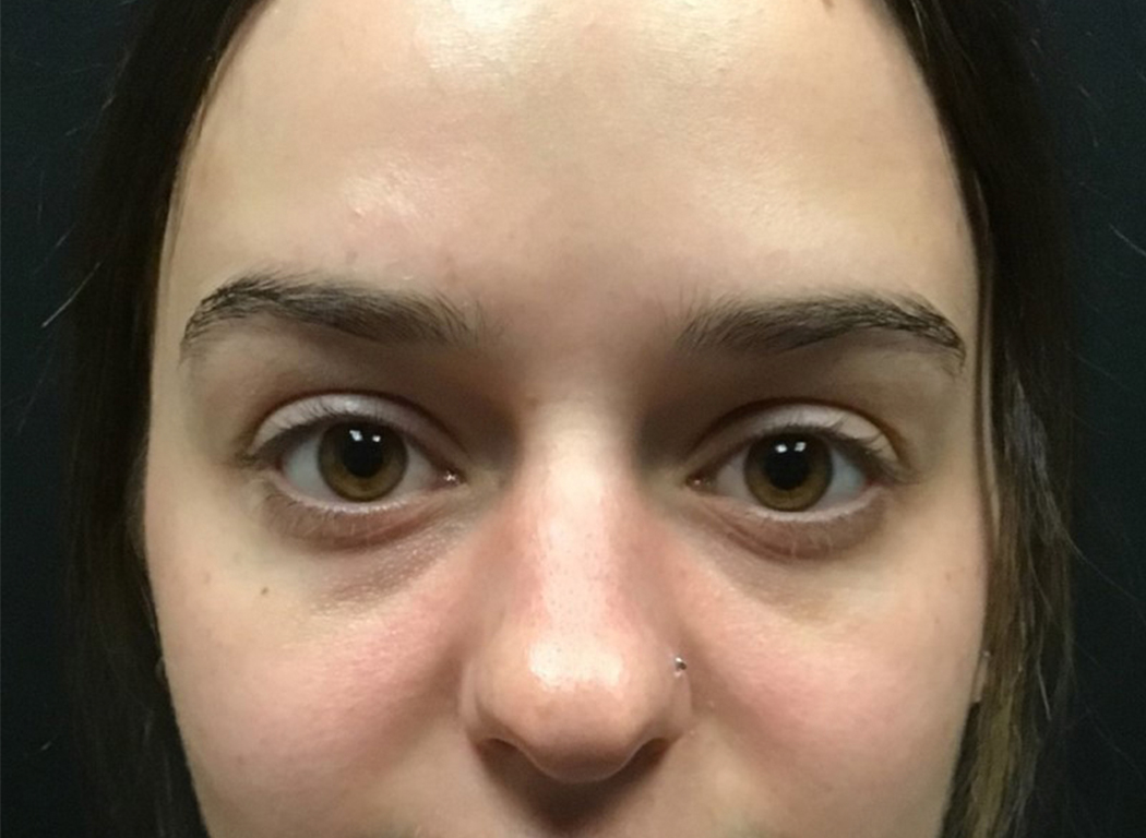 Patient #53343: Jeuveau After Image