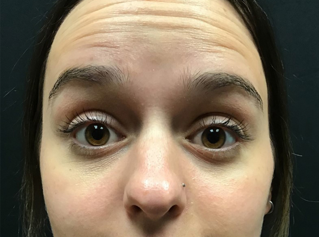Patient #53343: Jeuveau Before Image