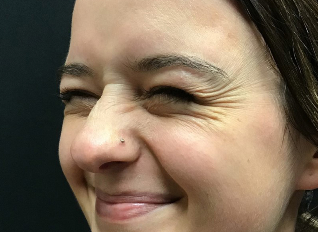 Patient #53343: Jeuveau Before Image