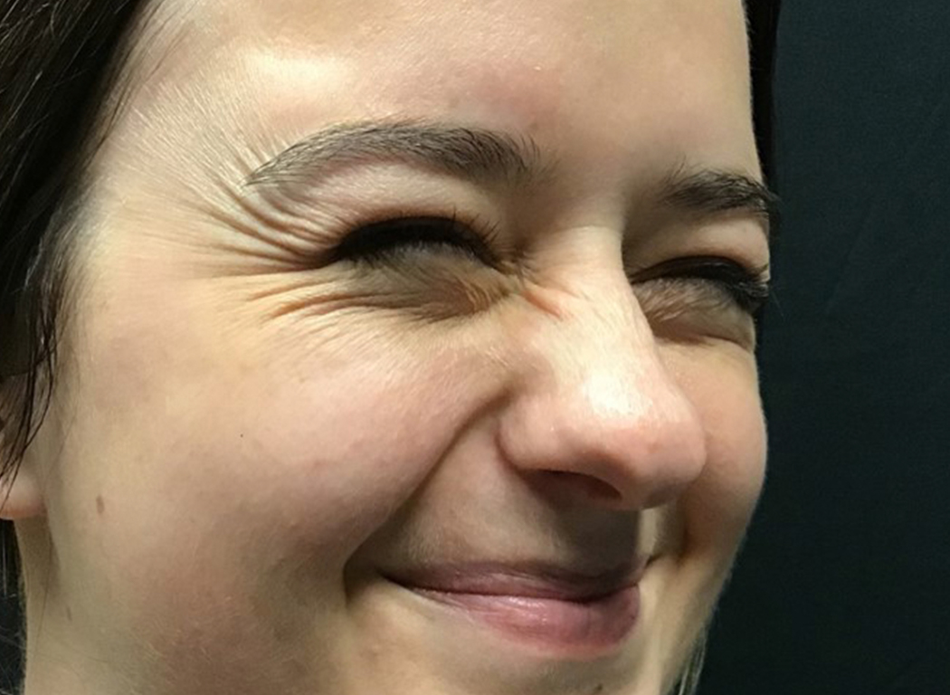 Patient #53343: Jeuveau Before Image