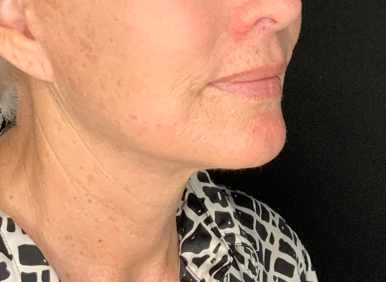 Patient #48183-2: Facelift, Neck Lift, Fat Injections, & Morpheus8 Resurfacing After Image