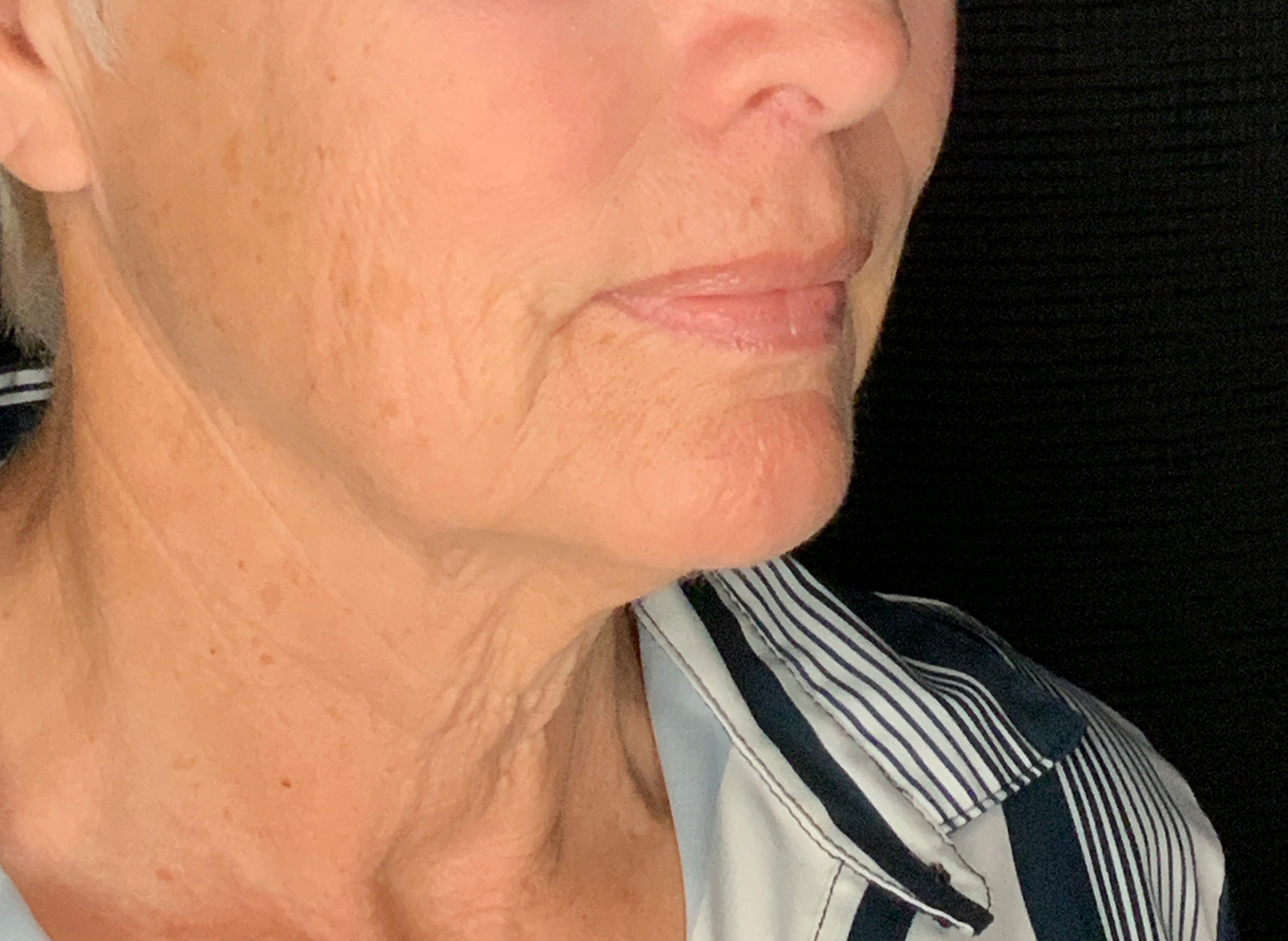 Patient #48183-2: Facelift, Neck Lift, Fat Injections, & Morpheus8 Resurfacing Before Image