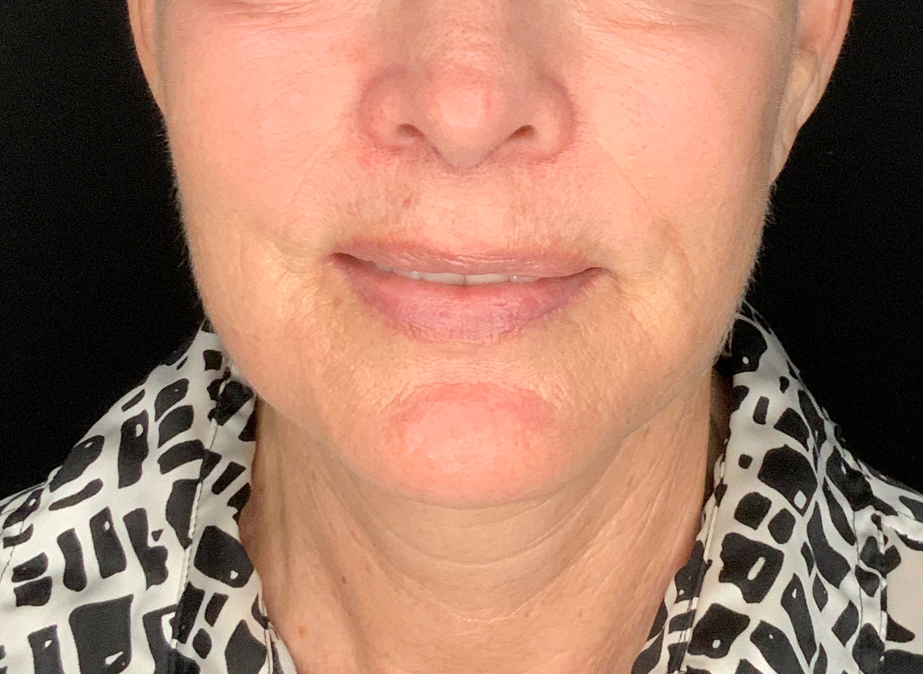 Patient #48183-2: Facelift, Neck Lift, Fat Injections, & Morpheus8 Resurfacing After Image