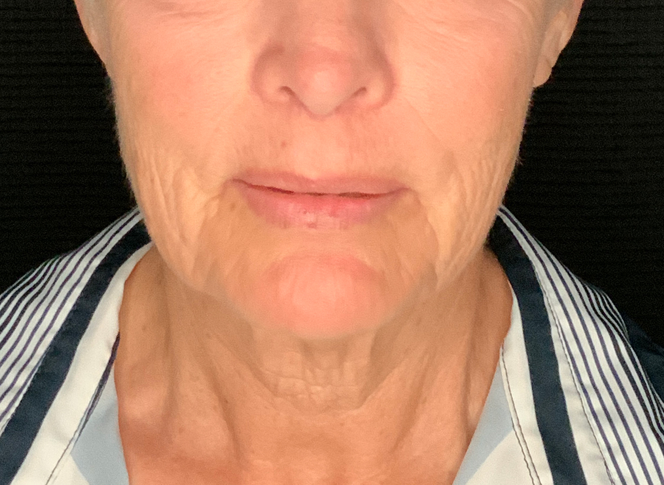 Patient #48183-2: Facelift, Neck Lift, Fat Injections, & Morpheus8 Resurfacing Before Image