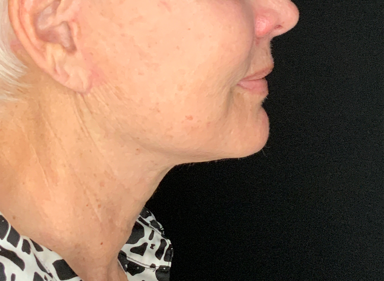 Patient #48183-2: Facelift, Neck Lift, Fat Injections, & Morpheus8 Resurfacing After Image