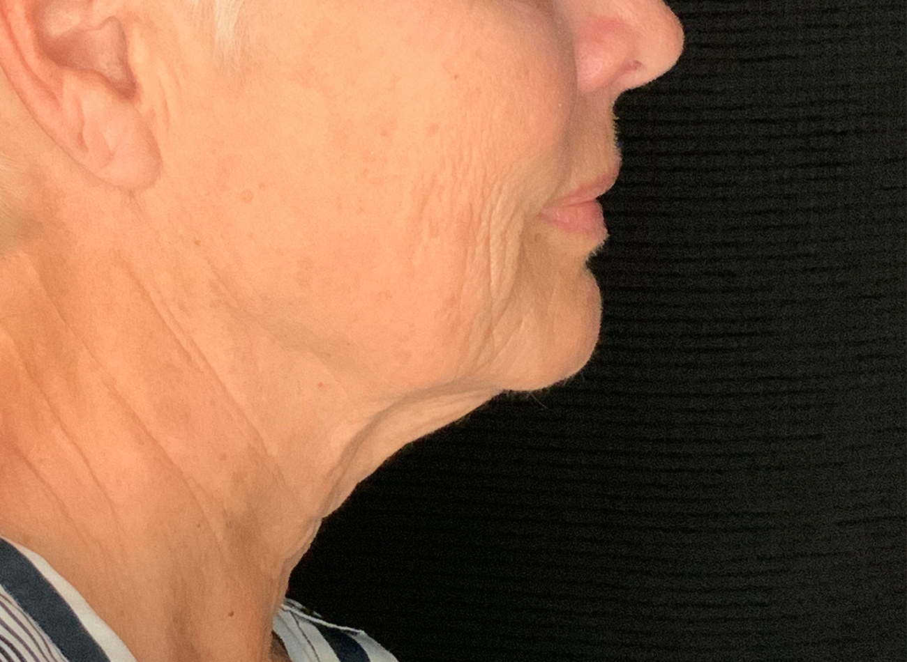 Patient #48183-2: Facelift, Neck Lift, Fat Injections, & Morpheus8 Resurfacing Before Image