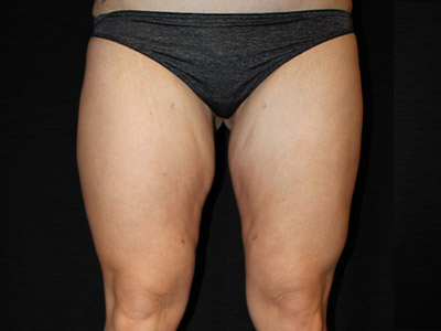Patient #17197: BodyTite After Image