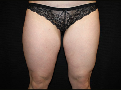 Patient #17197: BodyTite Before Image