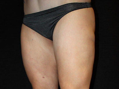 Patient #17197: BodyTite After Image