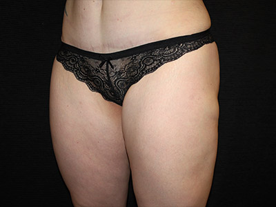 Patient #17197: BodyTite Before Image