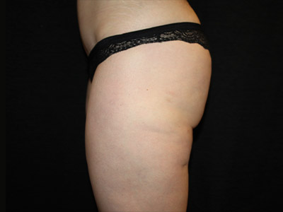 Patient #17197: BodyTite Before Image