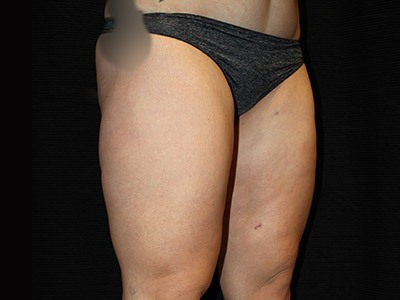 Patient #17197: BodyTite After Image