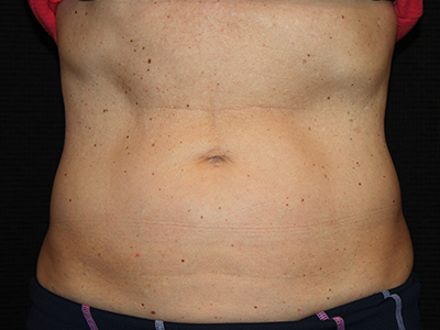 Patient #35382: BodyTite to Abdomen with Liposuction After Image