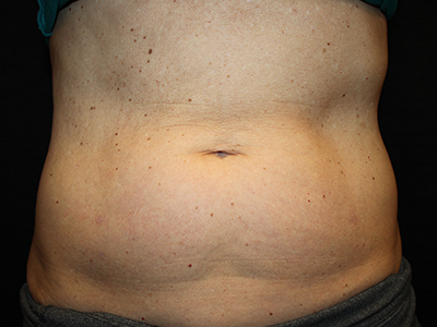 Patient #35382: BodyTite to Abdomen with Liposuction Before Image