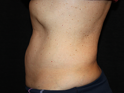 Patient #35382: BodyTite to Abdomen with Liposuction After Image