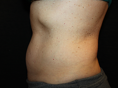 Patient #35382: BodyTite to Abdomen with Liposuction Before Image