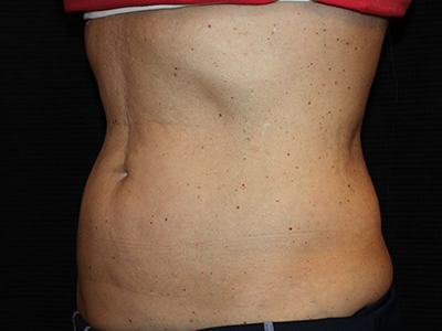 Patient #35382: BodyTite to Abdomen with Liposuction After Image