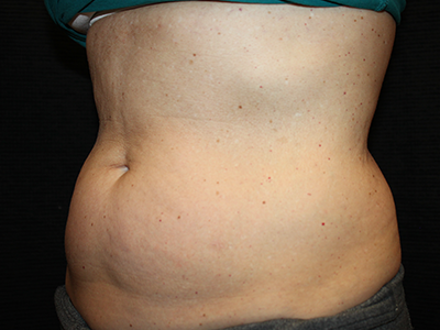 Patient #35382: BodyTite to Abdomen with Liposuction Before Image