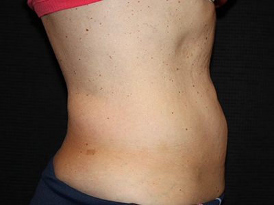 Patient #35382: BodyTite to Abdomen with Liposuction After Image