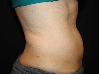 Patient #35382: BodyTite to Abdomen with Liposuction Before Image