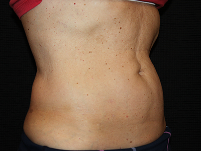 Patient #35382: BodyTite to Abdomen with Liposuction After Image