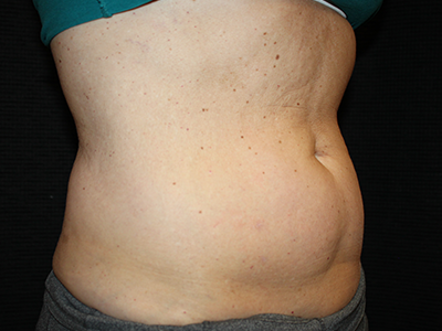 Patient #35382: BodyTite to Abdomen with Liposuction Before Image