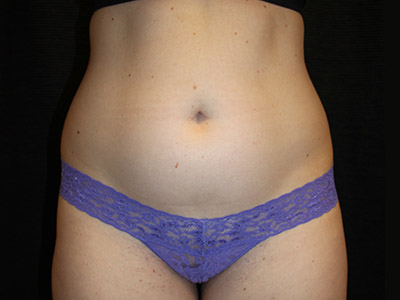 Patient #45072: BodyTite Before Image