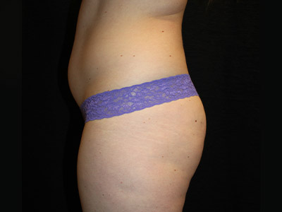 Patient #45072: BodyTite Before Image