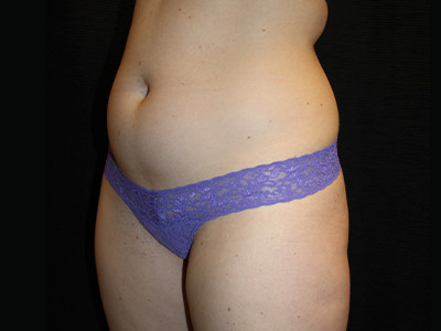 Patient #45072: BodyTite Before Image