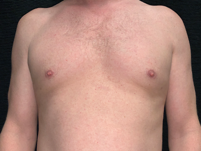 Patient #96653: BodyTite to Chest with Liposuction After Image