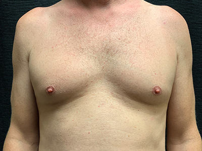 Patient #96653: BodyTite to Chest with Liposuction Before Image