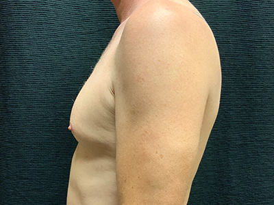 Patient #96653: BodyTite to Chest with Liposuction Before Image