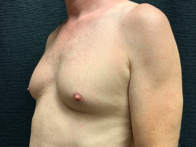 Patient #96653: BodyTite to Chest with Liposuction Before Image
