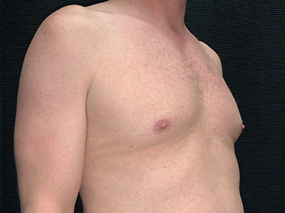 Patient #96653: BodyTite to Chest with Liposuction After Image