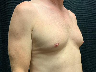 Patient #96653: BodyTite to Chest with Liposuction Before Image