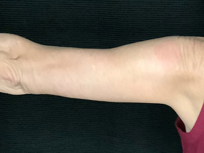 Patient #57342: Brachioplasty After Image