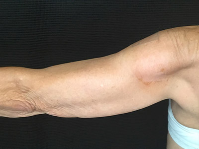 Patient #57342: Brachioplasty Before Image