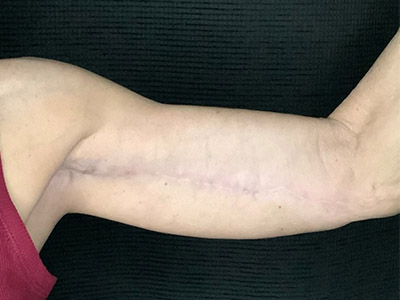 Patient #57342: Brachioplasty After Image